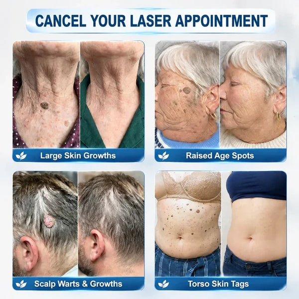 ✨Evolvion® 7-Day Skin Tag & Spot Eraser Painless & Scar-Free Advanced Imperfection RemovaI RoIIerbaII Pen 🌿