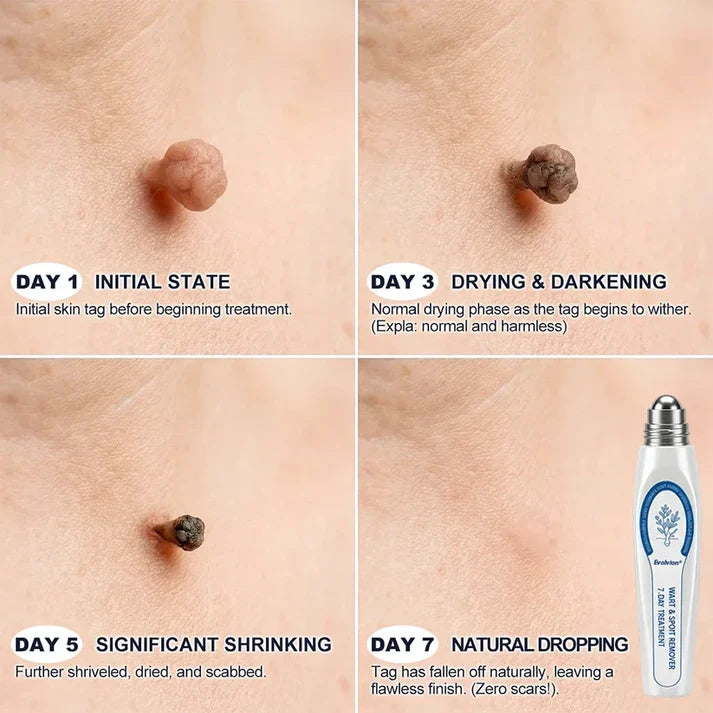 ✨Evolvion® 7-Day Skin Tag & Spot Eraser Painless & Scar-Free Advanced Imperfection RemovaI RoIIerbaII Pen 🌿