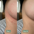💚 LAST DAY BUY 1 GET 1 FREE✨Intertrigo Relief Cream treats 99% of skin fold rashes from the first application Intertrigo Cream🛒